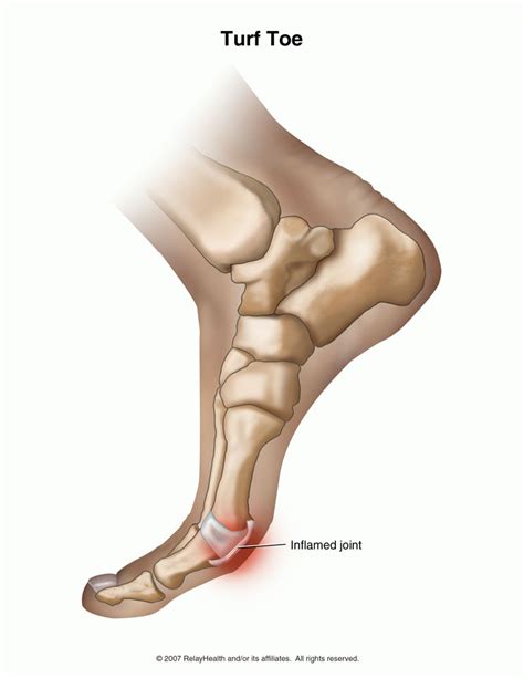 Turf toe is a common athletic injury. Turf Toe