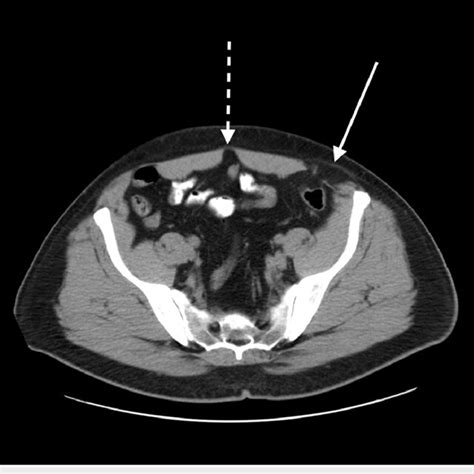 Ct Scan Of The Abdomen And Pelvis Without Contrast Which Displays A
