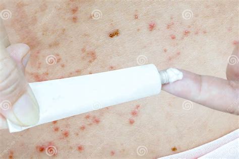 Shingles On Skin And Medicine Pharmaceutical White Tube Packaging