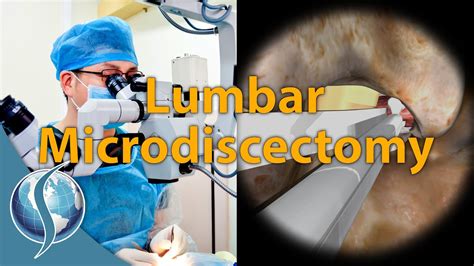 Lumbar Microdiscectomy Youtube