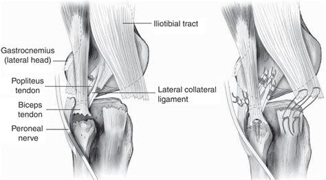 Posterolateral Corner Injury Knee Sports Orthobullets