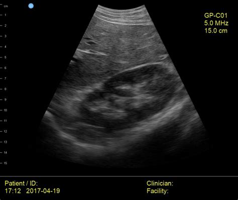 Interson Gp Medical Liver Kidney Diaphragm Ultrasound Image Interson