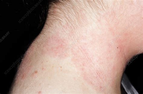 Eczema On The Neck Stock Image C0110367 Science Photo Library