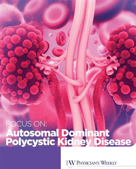 Focus On Autosomal Dominant Polycystic Kidney Disease Adpkd Ebook