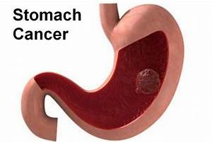 Stomach Cancer Causes Symptoms Diagnosis And Treatment Health And