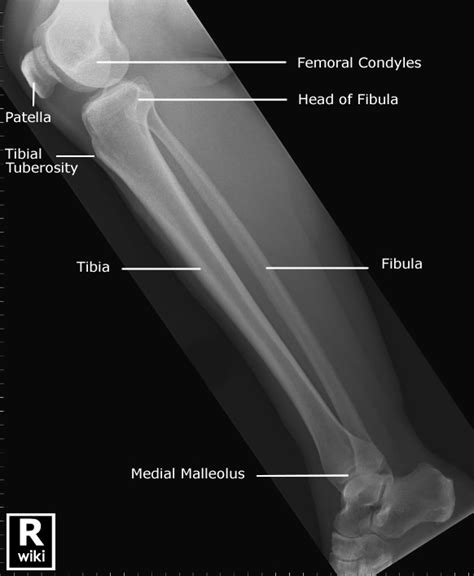 Tibfib Radiographic Anatomy Wikiradiography