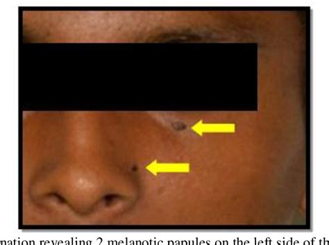 Figure 1 From Nevoid Basal Cell Carcinoma Syndrome A Case Report