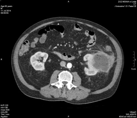 Ct Appearance Of Renal Abscess Eurorad
