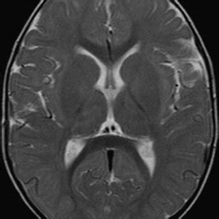 Mri Obtained Week After The First Mri Study A Axial T W Sequence