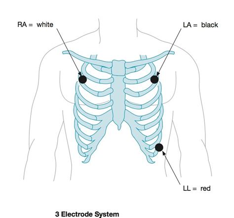 Ecg Ekg Cardiac Monitoring Litfl Ecg Llibrary