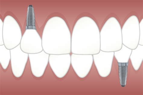 Permanent Teeth Replacement Options Dental Implants Gordon Dental