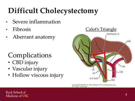 Socal Acs 2014 Subtotal Cholecystectomies
