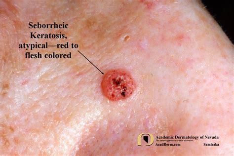 Seborrheic Keratosis Atypical Forms Academic Dermatology Of Nevada