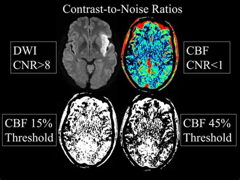 Current State Of Acute Stroke Imaging Stroke