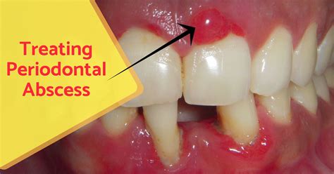 Periodontal Abscess Details And Treatment Expert Dental Care
