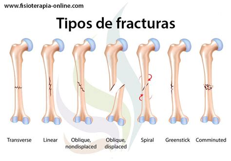 Fracturas óseas Tipos Cuidados Y Tratamiento Fisioterapia Online