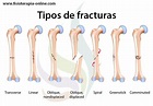 Fracturas óseas, tipos, cuidados y tratamiento | Fisioterapia Online