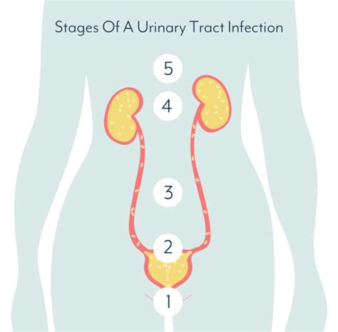 What Causes A Urinary Tract Infection And How Do You Get Rid Of A Uti
