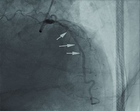 Proximal Part Of Lad Shows 90 95 Stenosis Arrows Download