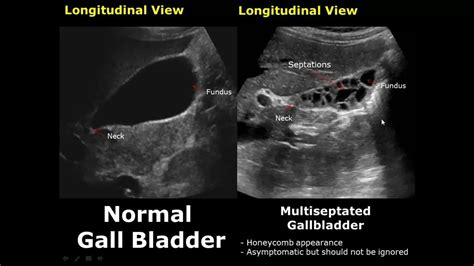 Gallbladder Ultrasound Normal Vs Abnormal Image Appearances Comparison