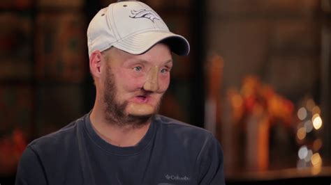Mayo Clinics First Face Transplant The Patient Youtube