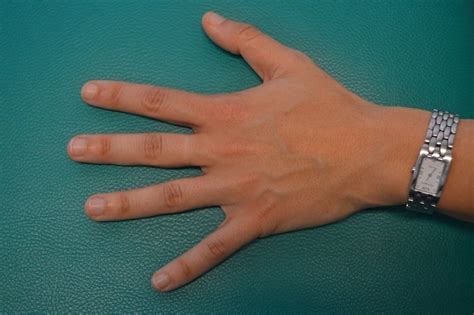 Fingerschmerzen Ursachen Was Tun Arten Verletzung Bilder Bruch