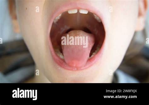 Wide Open Mouth With A Tongue Stuck Out View Of The Uvula And The Soft
