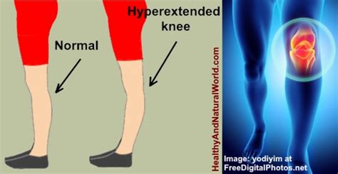 Hyperextended Knee Causes Treatments And Prevention