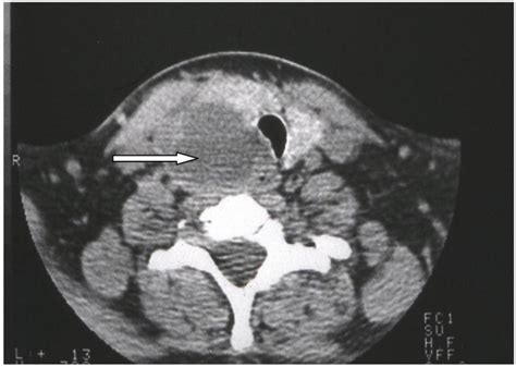 Enhanced Neck Computed Tomography Showing A Cystic Mass Arrow At The