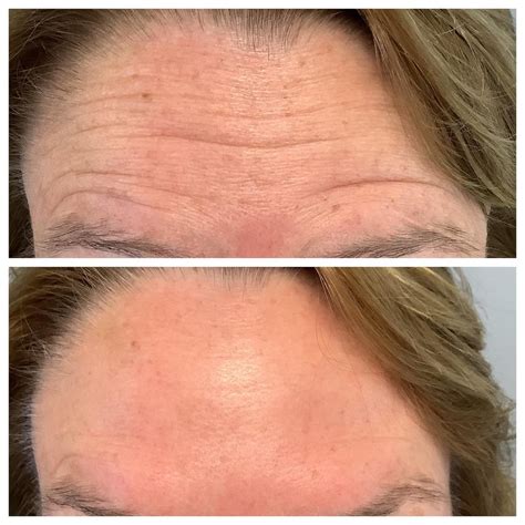 Wrinkle Relaxer Treatment Rhode Island Juveau Xeomin Botox Dysport