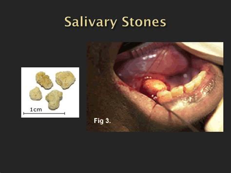 Salivary Stone