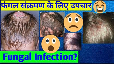 Cure Fungal Infection On Scalpheadhairbeard उपचार बालों पर फंगल