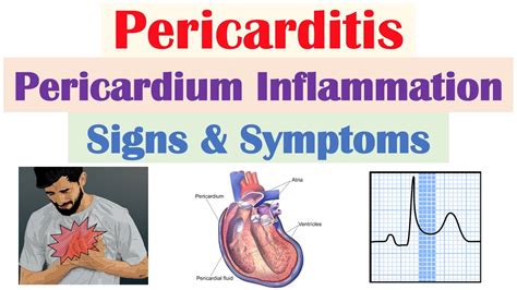 Pericarditis Pericardial Inflammation Signs And Symptoms And Why They