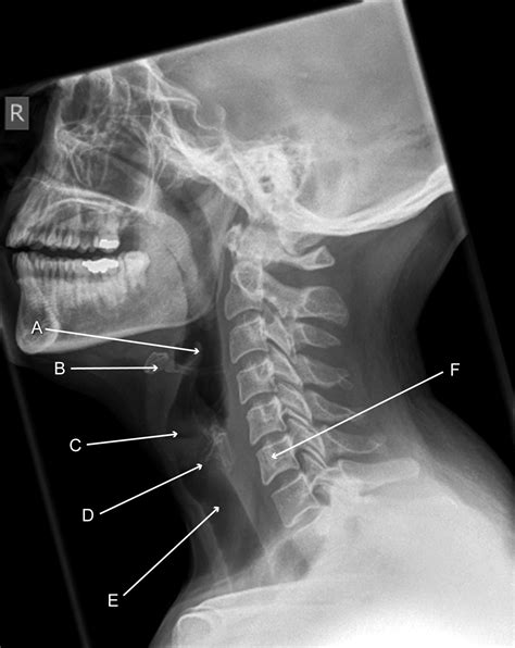 Normal Lateral Soft Tissue Radiograph Of The Neck In A Paediatric The Best Porn Website