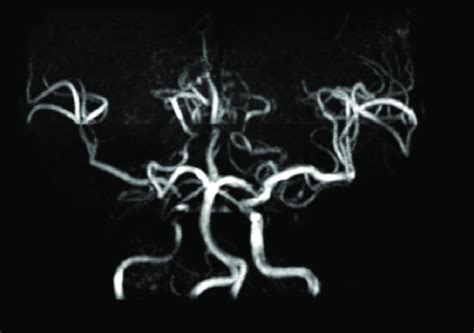 MRA Showed Stenosis Of Right ICA ICA Internal Carotid Artery MRA