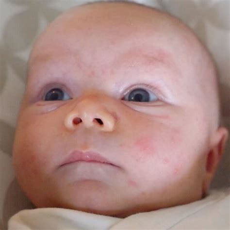 Milenium Home Tips Baby Acne On Eyelids