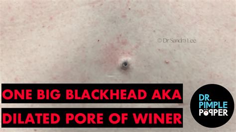 One Big Blackhead Aka Dilated Pore Of Winer Dr Pimple Popper