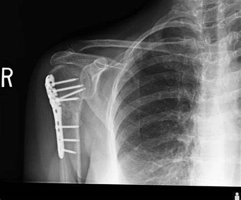 Causes Of Clavicle Fracture Surgery For Clavicle Fracture Broken