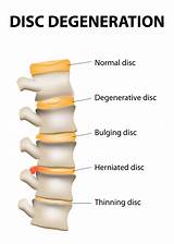 Chiropractic Treatment For Herniated Disc Pictures