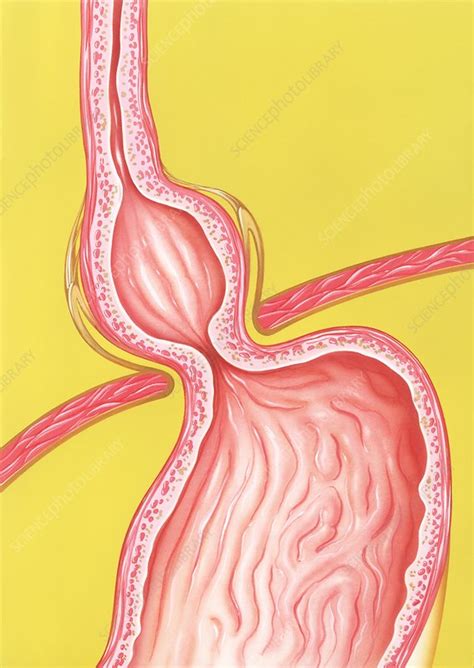 Hiatus Hernia Illustration Stock Image C0290652 Science Photo