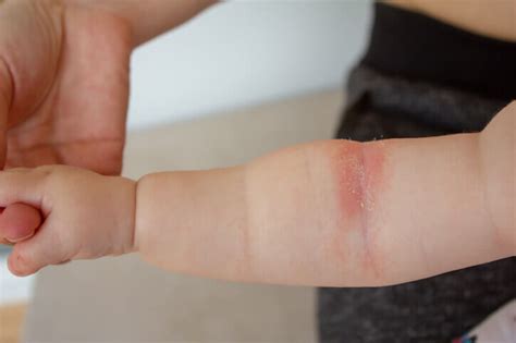 Contact Dermatitis Wrist