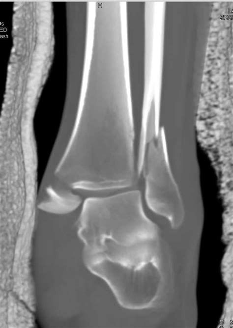 Fracture Of Distal Tibia And Fibula With Widening Of Ankle Mortise