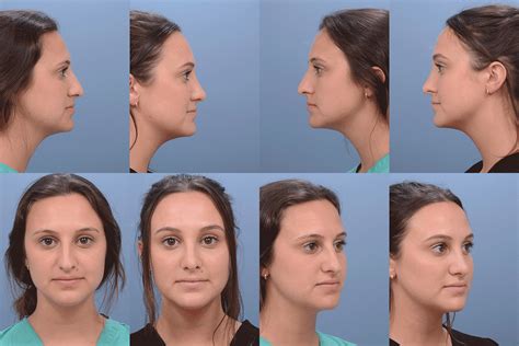 Rhinoplasty Before And After Photos Ernesto J Ruas Md