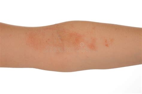 Eczema On Skin Stock Photo Image Of Sclerosis Closeup 8959704