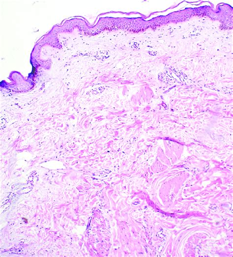 Histopathology H And E ×10 Showing Dermal Edema Fenestrations And