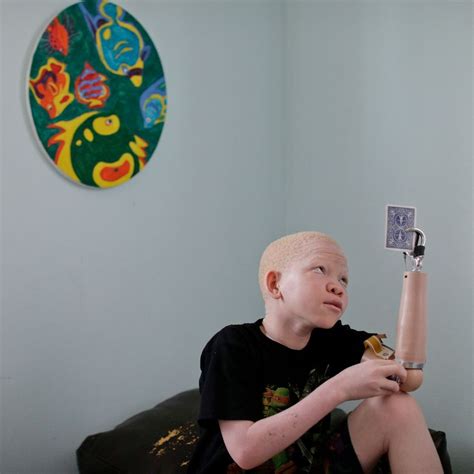 1st Of Tanzanian Albino Kids With Missing Limbs Goes Home The Seattle