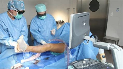 Steam Ablation Treatment By The Worlds Best Vascular Surgeon