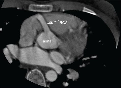 Diagonals can be defined as a line joining the two nonadjacent vertices of a polygon. Anomalous Origin of the Left Coronary Artery from the Pulmonary Artery: Diagnosis with CT ...