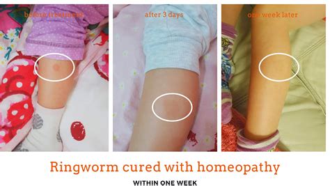 Ringworm Treatment Gentle Healing Homeopathy Dublin 15 And Online