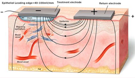 Electrical Stimulation In Wound Healing Wetling